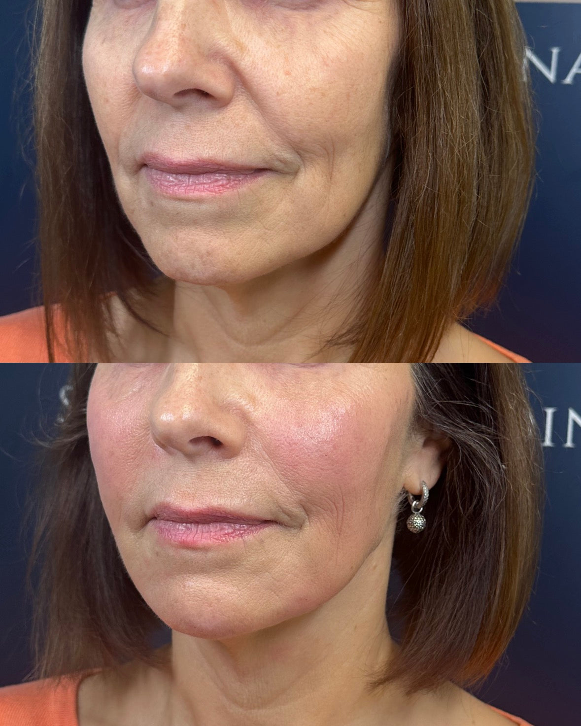 Fillers kinder skincare scandinavia Lomma