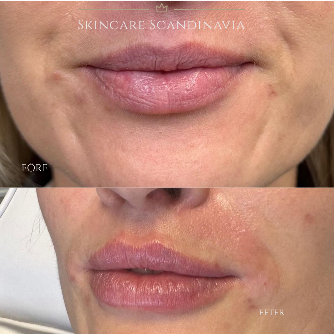 Före/efter läppar fillers botox