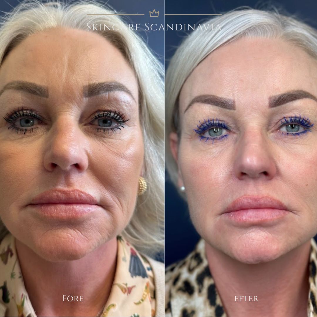 Skinboosters skönhetsbehandlingar Lomma Skincare Scandinavia