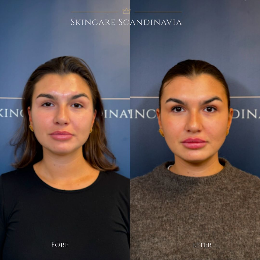 Botoxbehandling Skincare Scandinavia Lomma