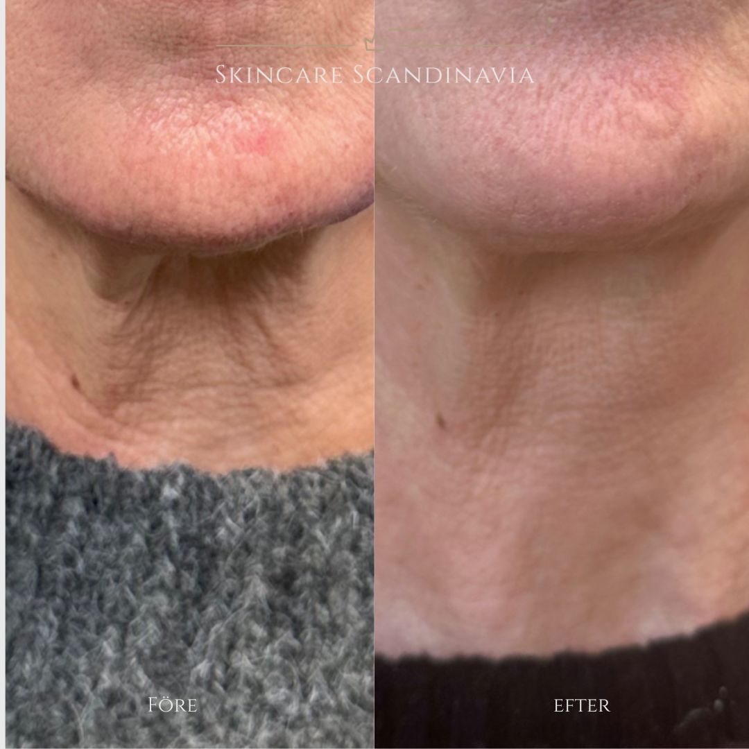 Skincare Scandinavia Lomma Botoxbehandling hals