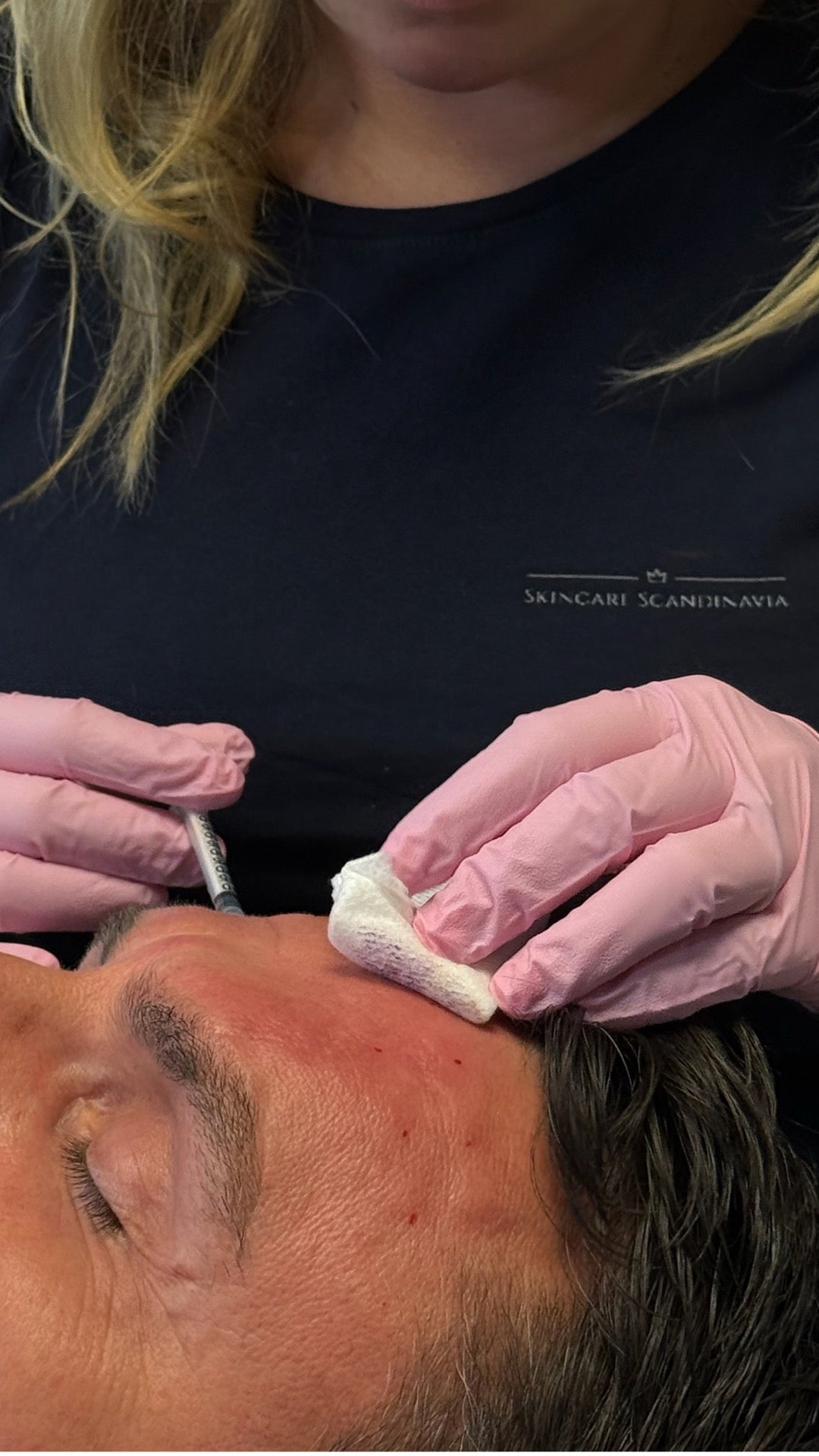 Botox behandling panna Skincare Scandinavia