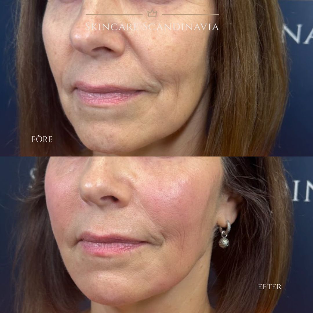 Fillers behandling Lomma Skincare Scandinavia