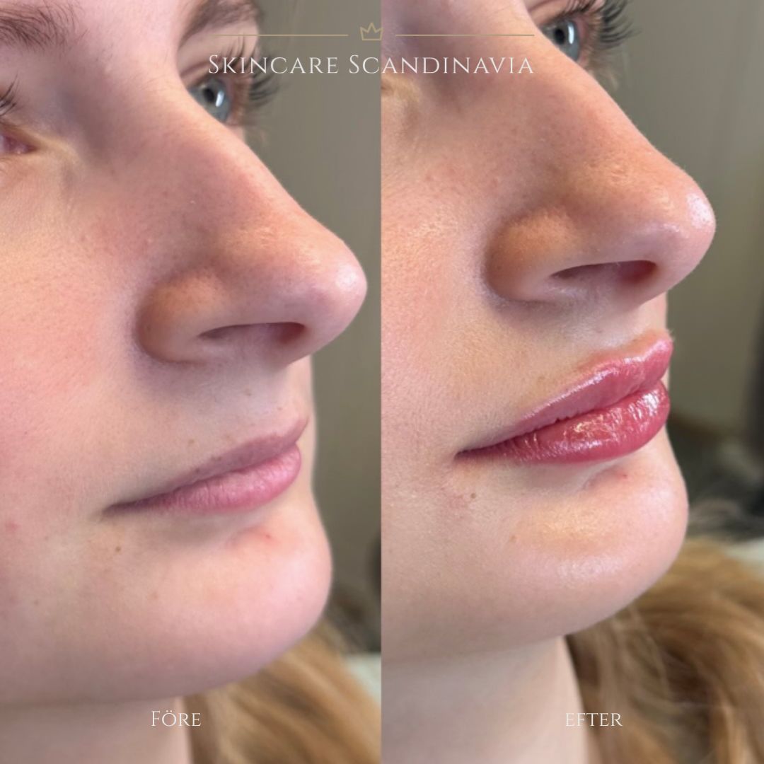 Fillers behandling Lomma Skincare Scandinavia