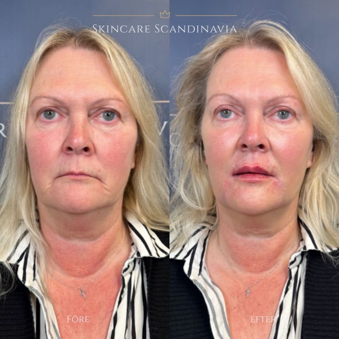 Fillers behandling Lomma Skincare Scandinavia