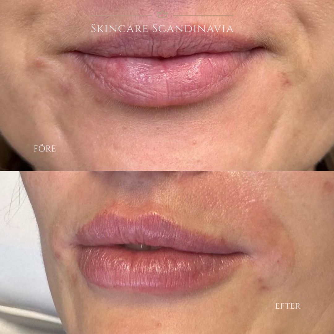 Fillers behandling Lomma Skincare Scandinavia