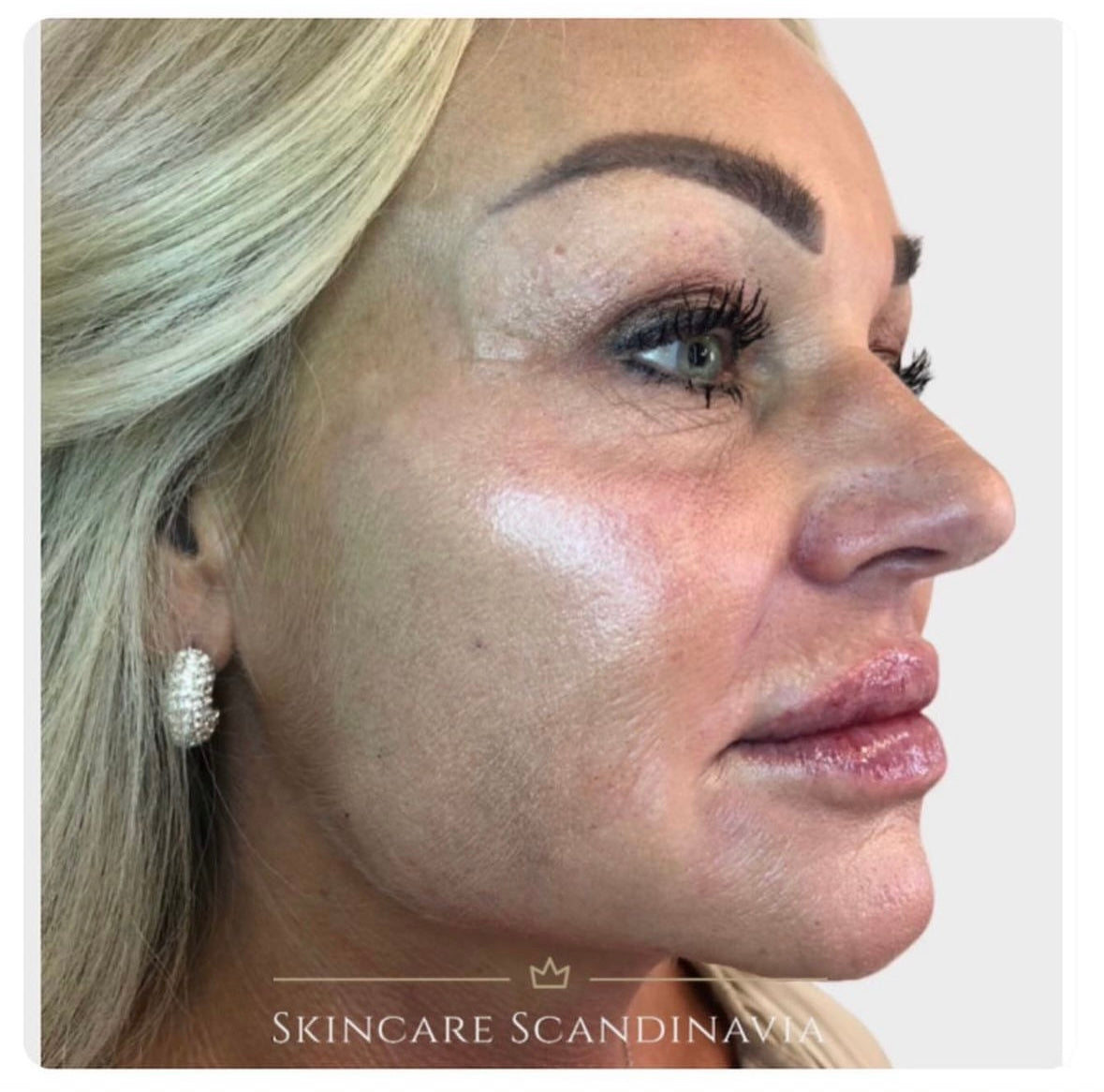 Skinbooster kollagen före efter Skincare Scandinavia Lomma