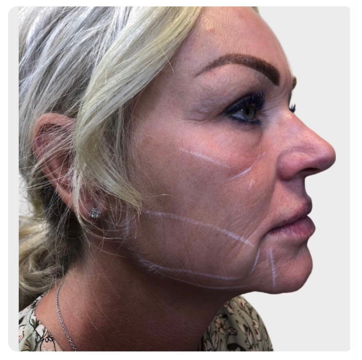 Skinbooster kollagen före Skincare Scandinavia Lomma Skåne