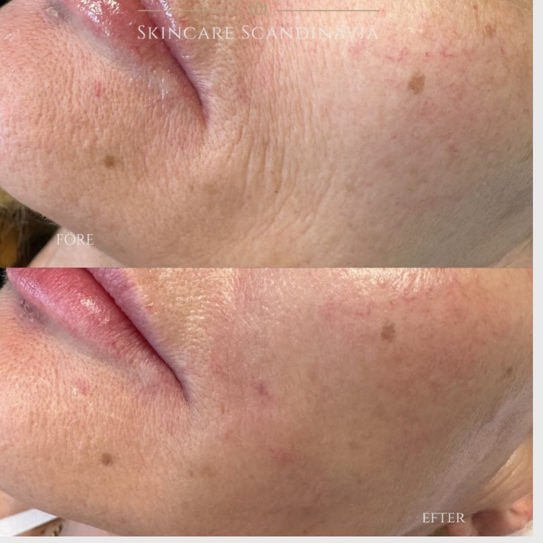 Skinboosters skönhetsbehandlingar Lomma Skincare Scandinavia 