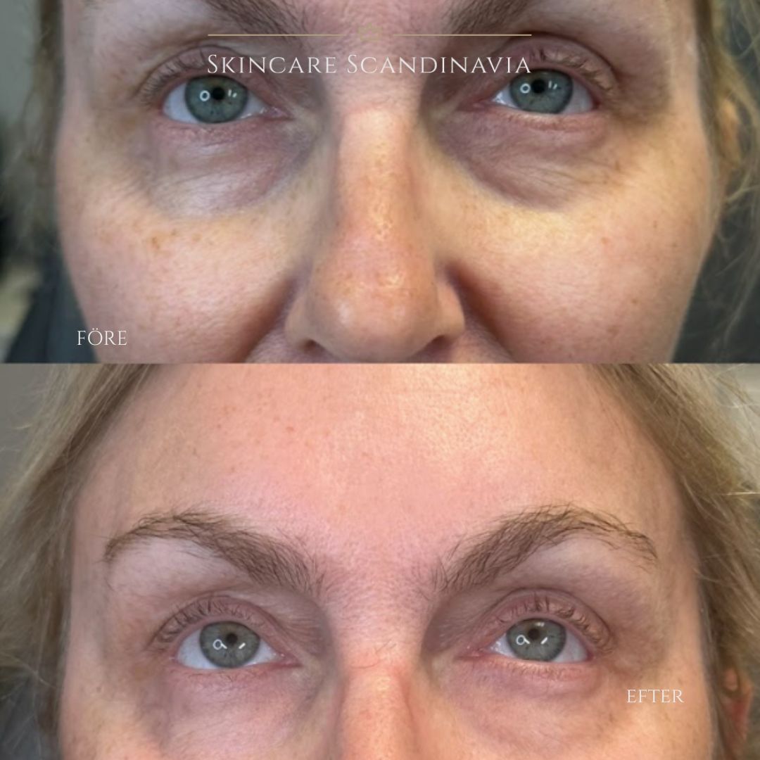 Skinboosters skönhetsbehandlingar Lomma Skincare Scandinavia 
