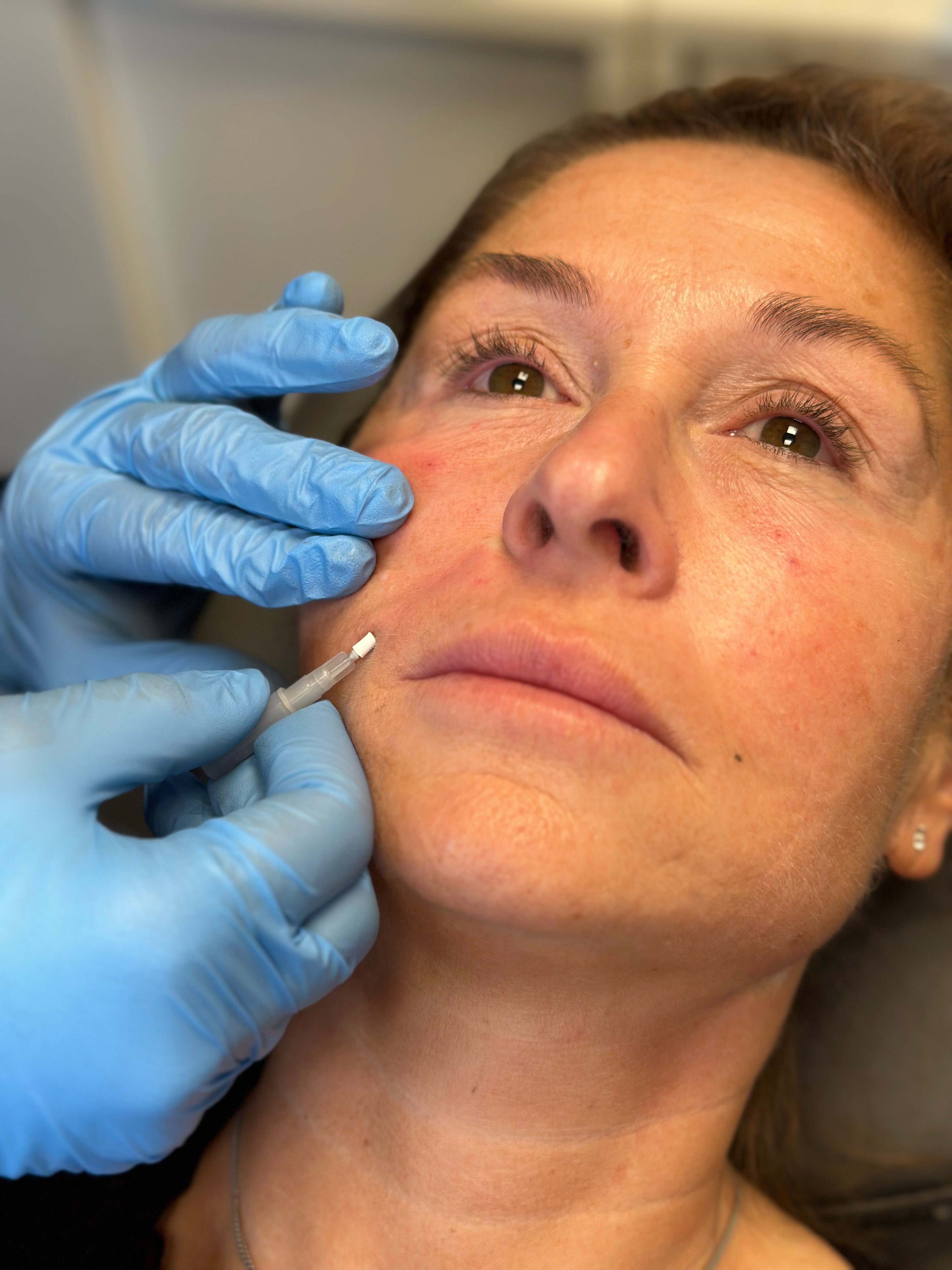 Trådlyft Lomma Skincare Scandinavia Skåne