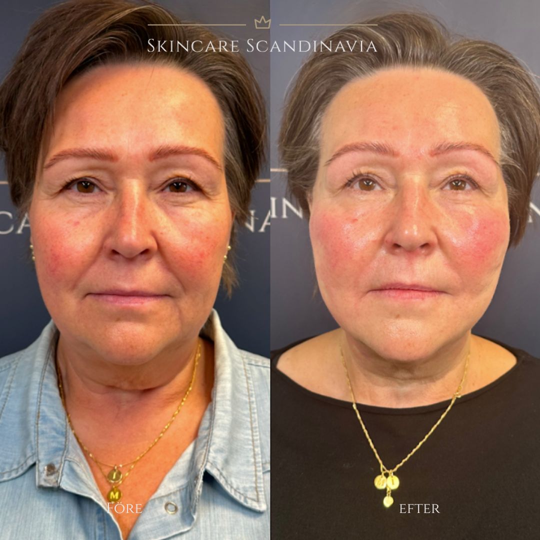 Trådlyft skincare scandinavia lomma skönhetsbehandlingar 