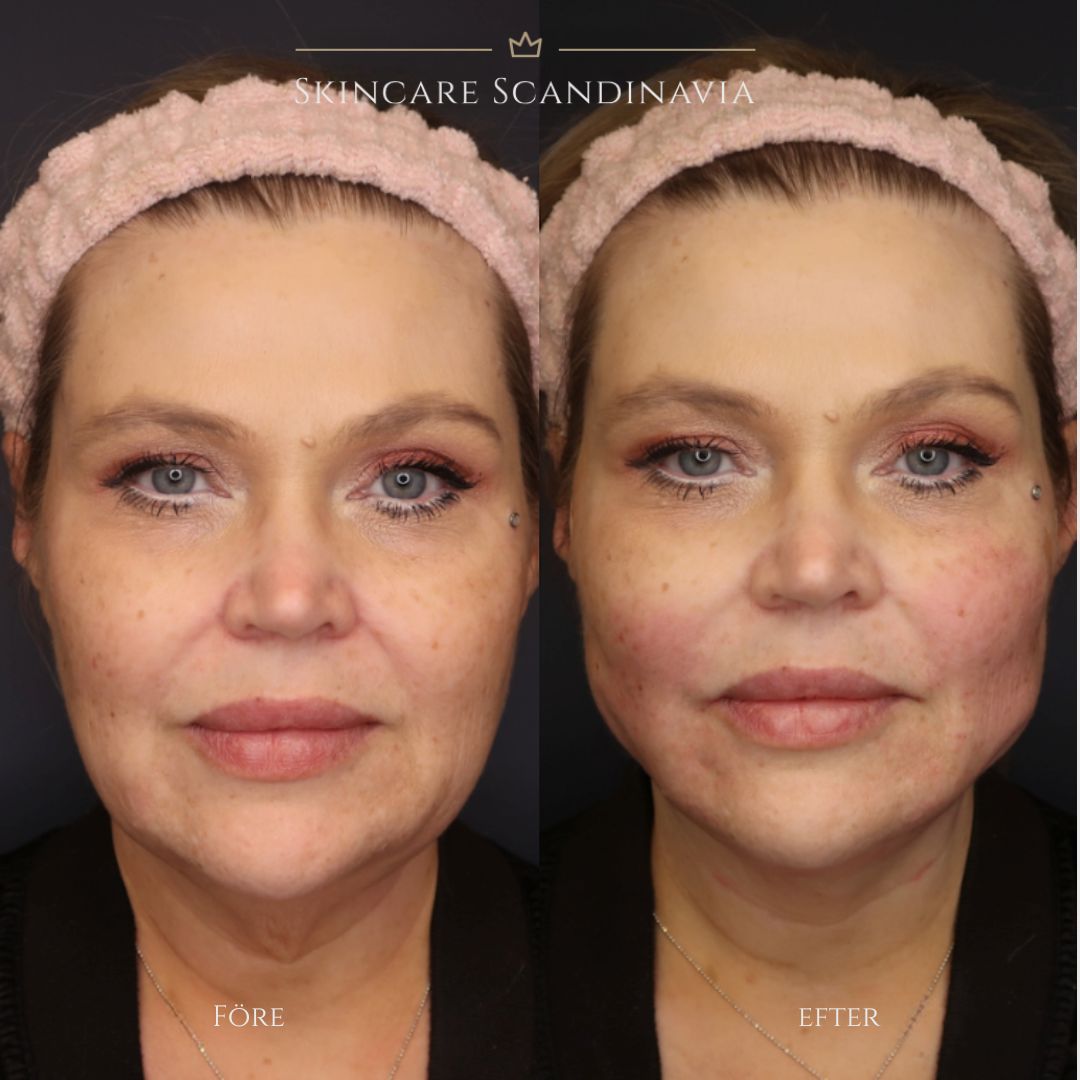 Trådlyft skincare scandinavia lomma skönhetsbehandlingar 