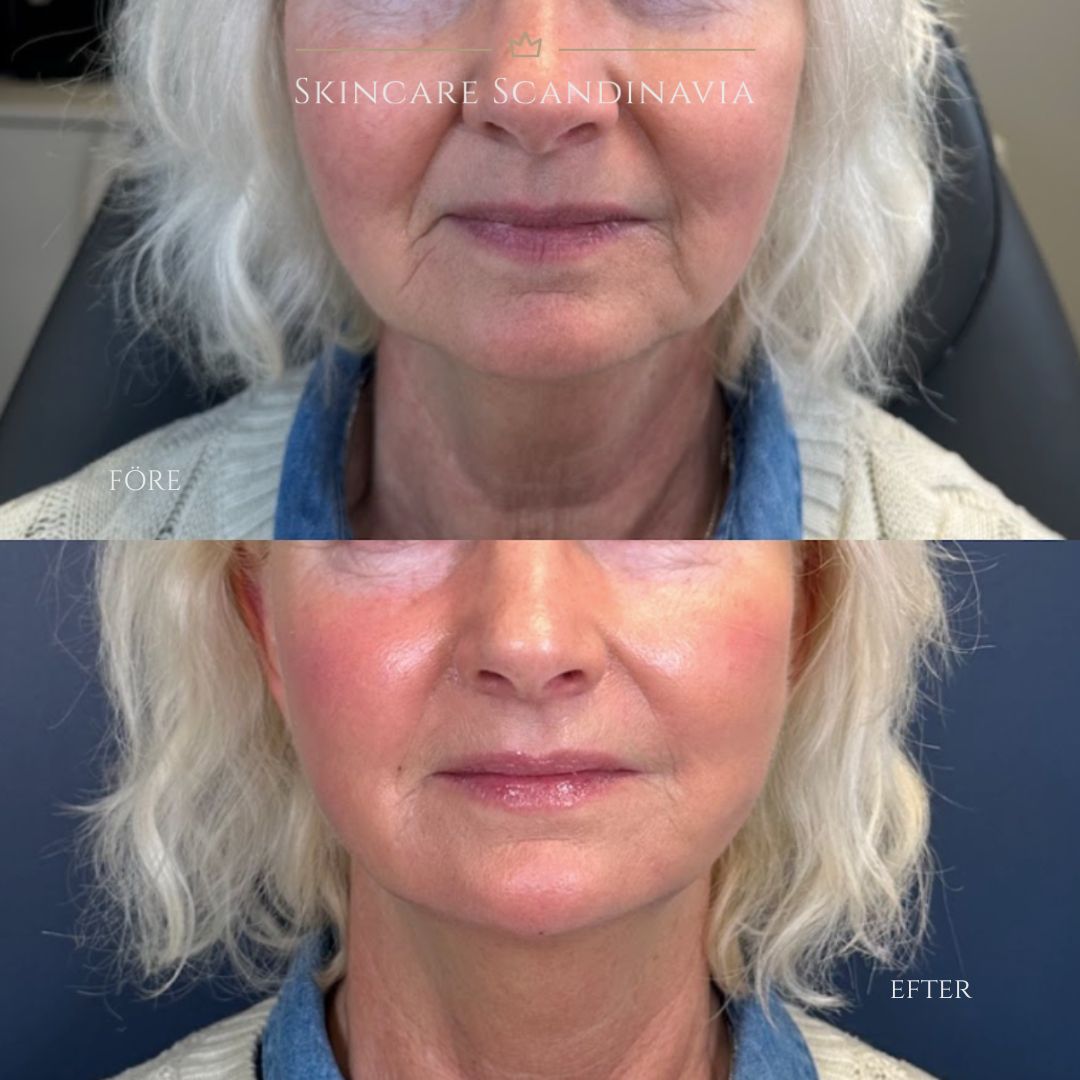 Trådlyft skincare scandinavia lomma skönhetsbehandlingar 