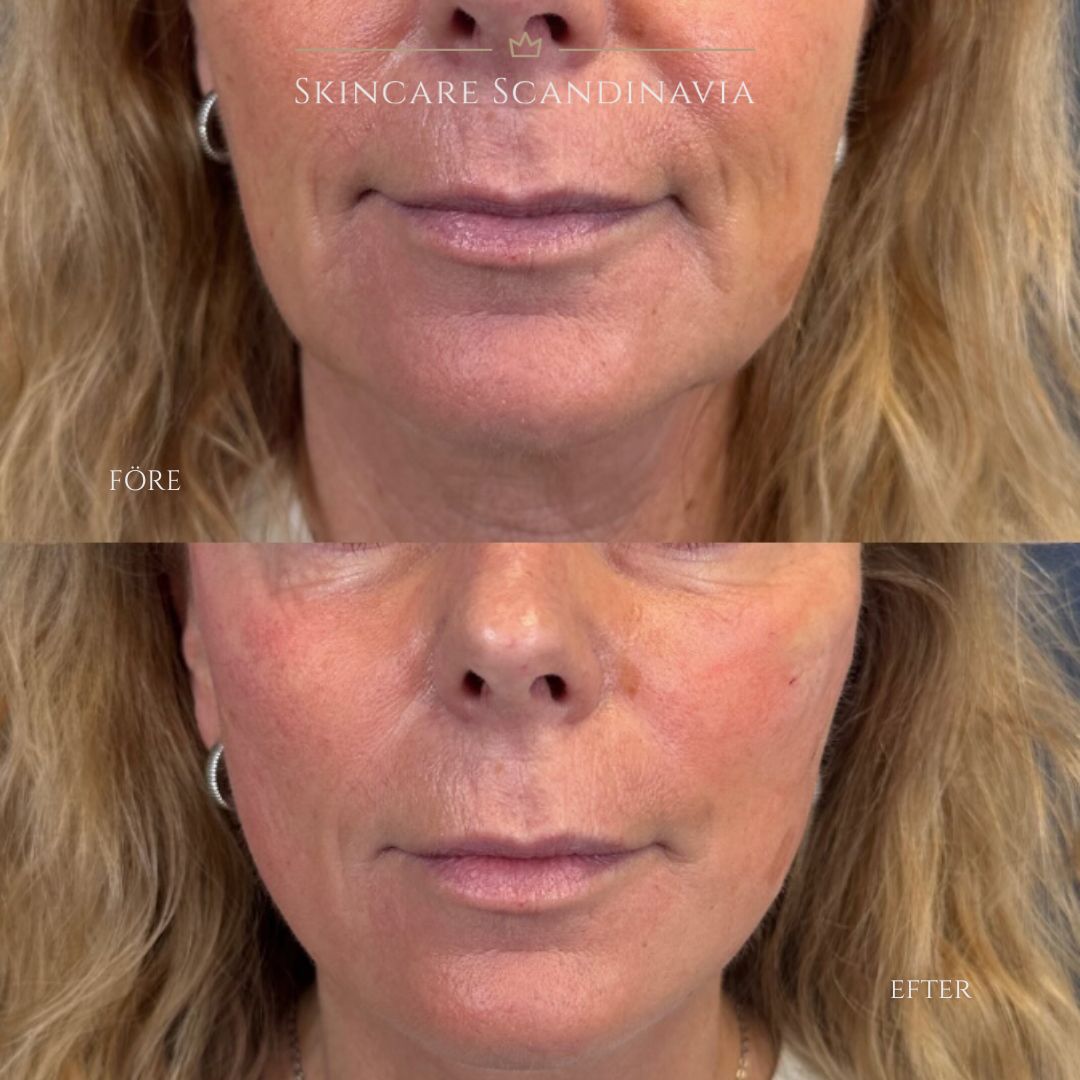 Trådlyft skincare scandinavia lomma skönhetsbehandlingar 