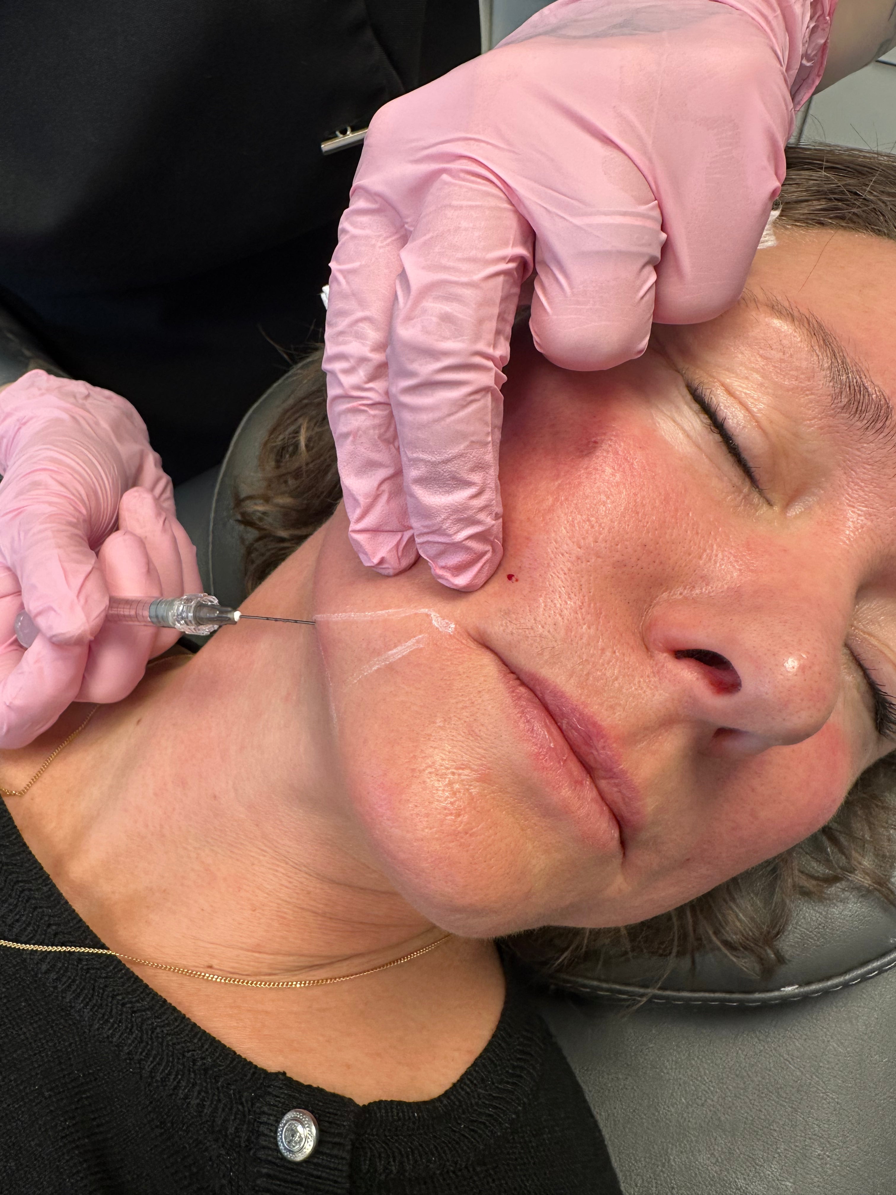 Utbildning Fillers sur mungipa Skincare Scandinavia Lomma