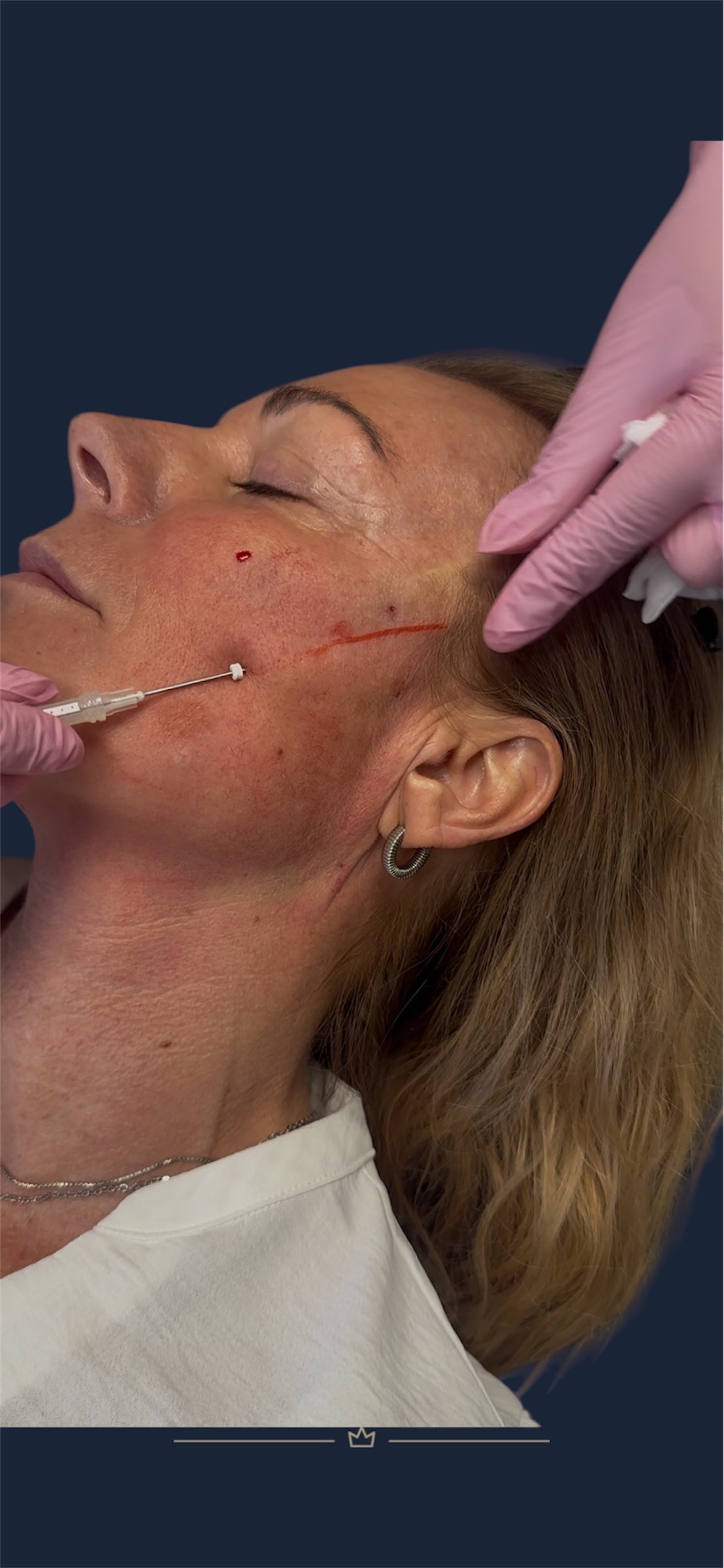 Utbildning trådar trådlyft skincare scandinavia lomma